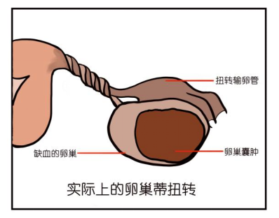 腹痛运动后右下腹痛_腹痛运动后缓解的病机_运动后腹痛