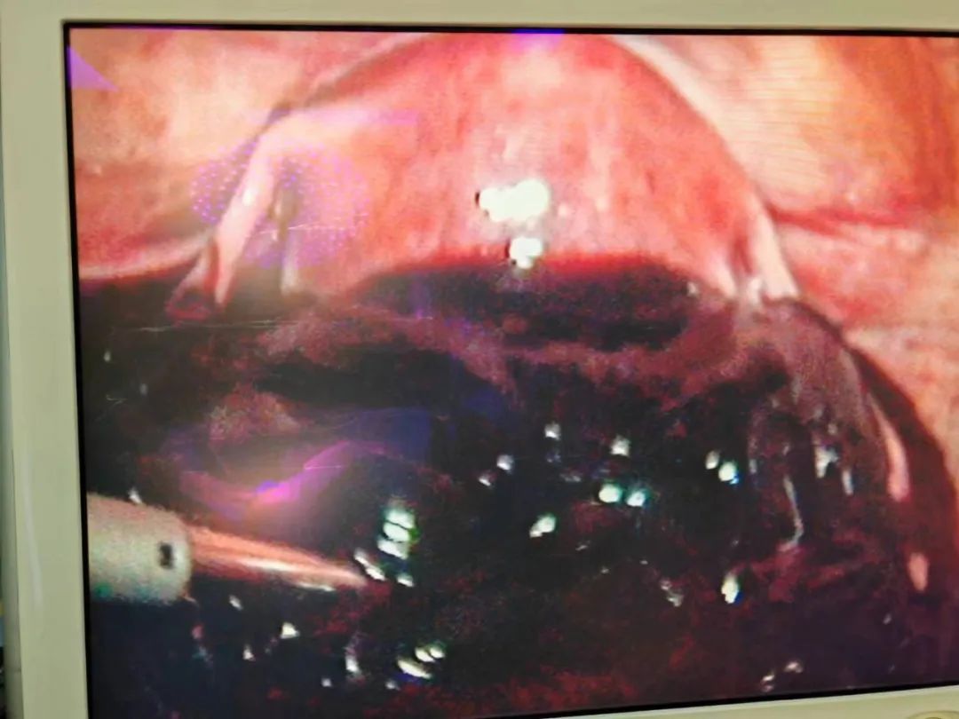 腹痛运动后右下腹痛_运动后腹痛_腹痛运动后就减轻